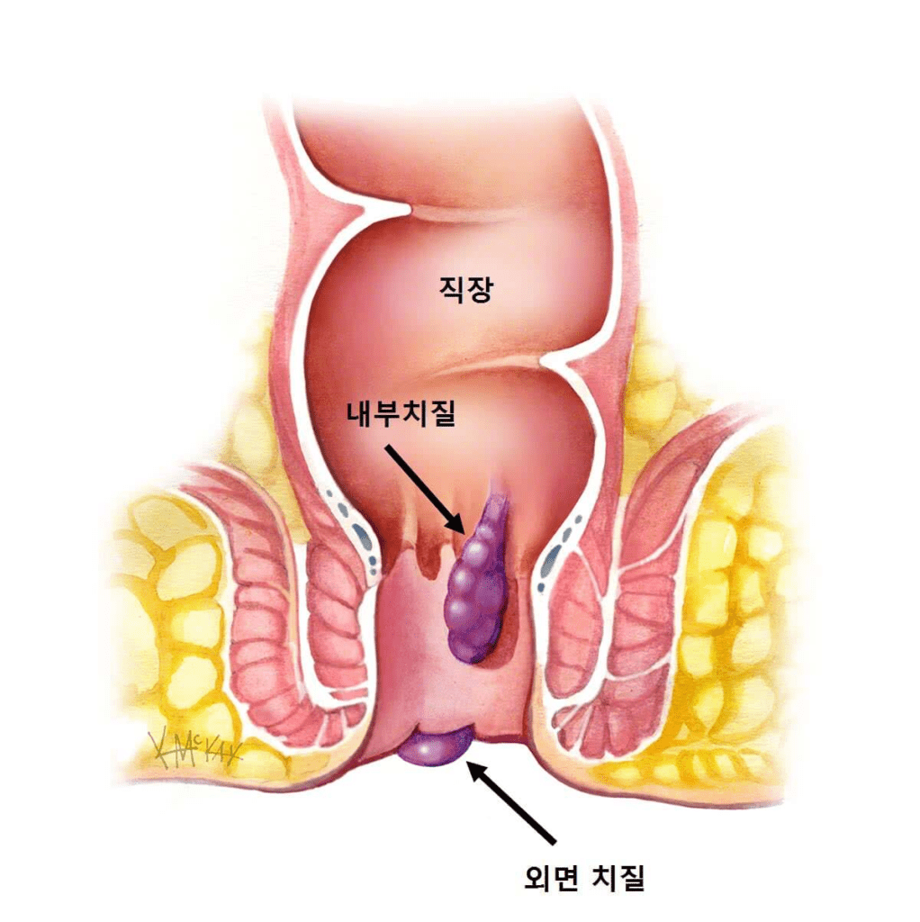 대장염